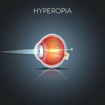 How Hyperopia Affects an Eye