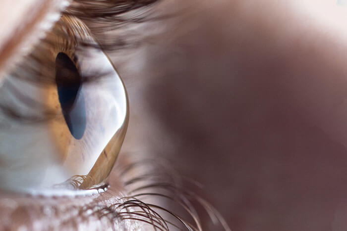 Closeup of an Eye With Keratoconus