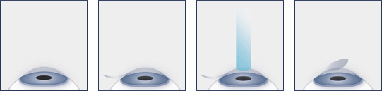 Chart Illustrating the LASIK Steps