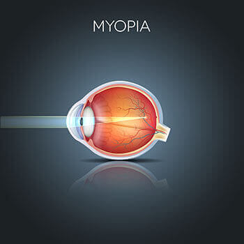 How Myopia Affects an Eye