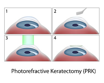 Chart Showing the PRK Surgery Process
